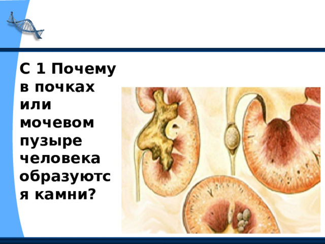 С 1 Почему в почках или мочевом пузыре человека образуются камни? 