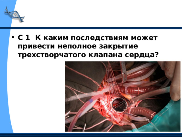 С 1 К каким последствиям может привести неполное закрытие трехстворчатого клапана сердца? 