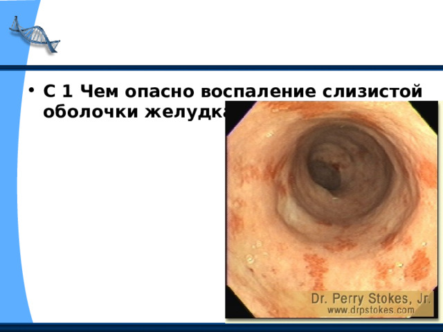 С 1 Чем опасно воспаление слизистой оболочки желудка? 