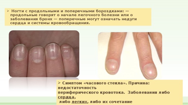 Что значат полосы на ногтях