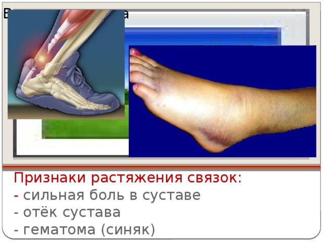 Вставка рисунка Признаки растяжения связок:  - сильная боль в суставе  - отёк сустава  - гематома (синяк) 