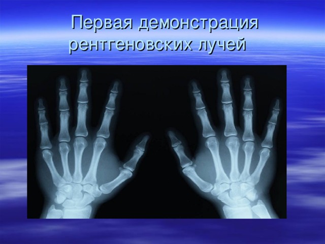   Первая демонстрация рентгеновских лучей  