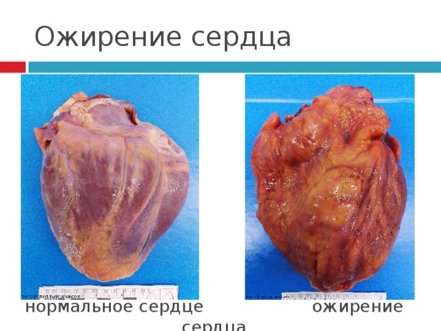 Ожирение сердца нормальное сердце ожирение сердца 