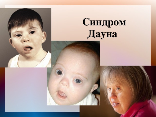 Синдром Дауна