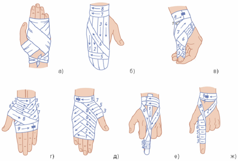 Как наложить эластичный бинт. Схема бинтования руки при переломе. Схемы бинтовых повязок. Бинтование руки бинтом. Повязка на кисть десмургия