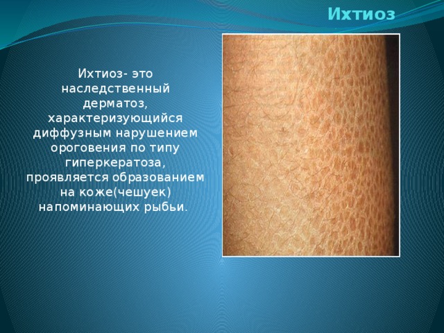 Ихтиоз   Ихтиоз- это наследственный дерматоз, характеризующийся диффузным нарушением ороговения по типу гиперкератоза, проявляется образованием на коже(чешуек) напоминающих рыбьи. 