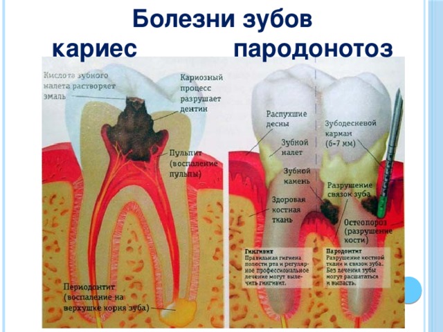 Болезни зубов кариес пародонотоз 