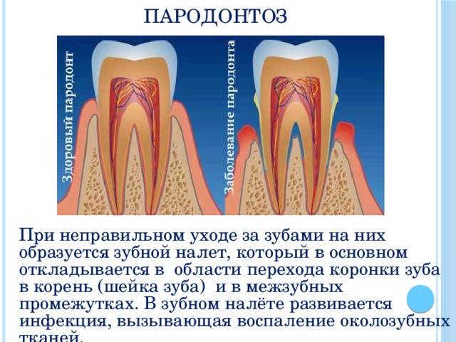 Пародонтоз При неправильном уходе за зубами на них образуется зубной налет, который в основном  откладывается в  области перехода коронки зуба в корень (шейка зуба)  и в межзубных промежутках. В зубном налёте развивается инфекция, вызывающая воспаление околозубных тканей. 
