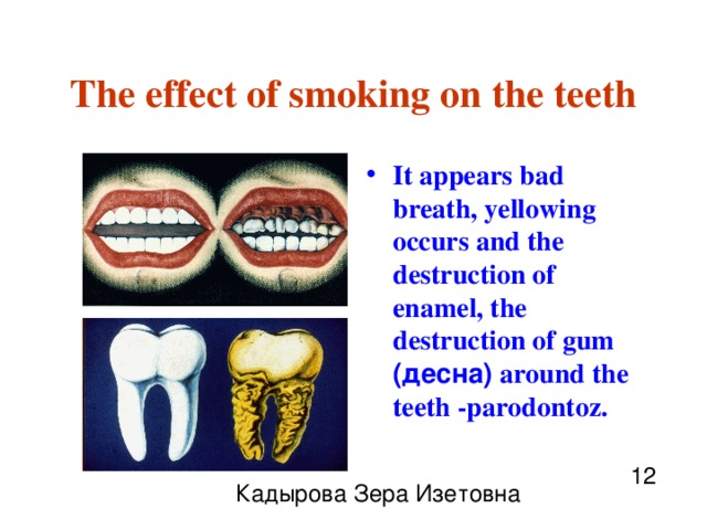 The effect of smoking on the teeth It appears bad breath, yellowing occurs and the destruction of enamel, the destruction of gum (десна) around the teeth -parodontoz. 12 Кадырова Зера Изетовна 