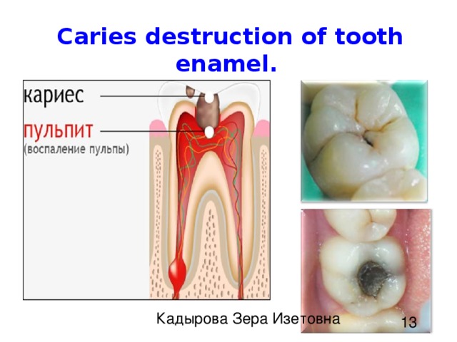 Caries destruction of tooth enamel.   Кадырова Зера Изетовна 13 