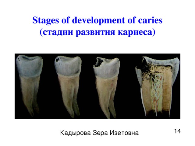 Stages of development of caries (стадии развития кариеса) 14 Кадырова Зера Изетовна 