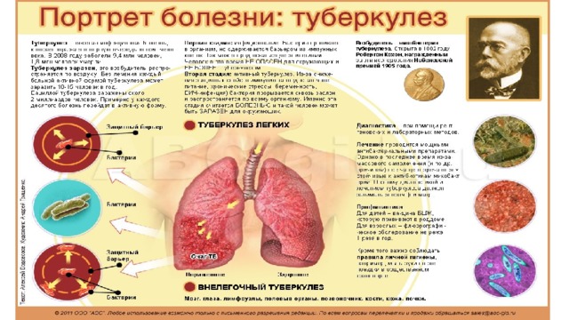 Проект на тему туберкулез