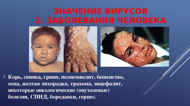 ЗНАЧЕНИЕ ВИРУСОВ  1. ЗАБОЛЕВАНИЯ ЧЕЛОВЕКА Корь, свинка, грипп, полиомиелит, бешенство, оспа, желтая лихорадка, трахома, энцефалит, некоторые онкологические (опухолевые) болезни, СПИД, бородавки, герпес. 