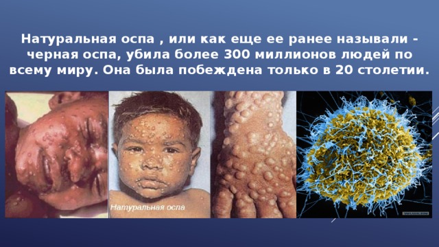Натуральная оспа , или как еще ее ранее называли - черная оспа, убила более 300 миллионов людей по всему миру. Она была побеждена только в 20 столетии. 