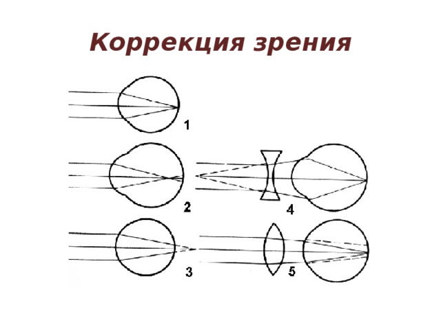 Коррекции зрения схема