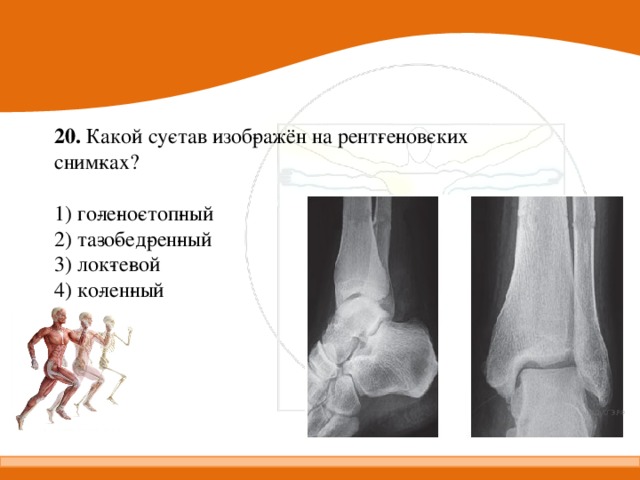 20.  Какой су­став изоб­ражён на рент­ге­нов­ских сним­ках? 1) го­ле­но­стоп­ный 2) та­зо­бед­рен­ный 3) лок­те­вой 4) ко­лен­ный 