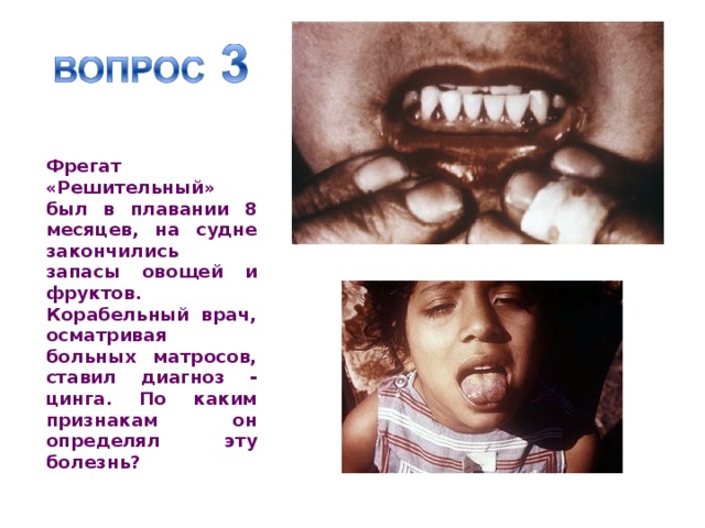  Фрегат «Решительный» был в плавании 8 месяцев, на судне закончились запасы овощей и фруктов. Корабельный врач, осматривая больных матросов, ставил диагноз - цинга. По каким признакам он определял эту болезнь? 