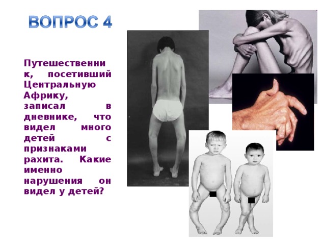 Путешественник, посетивший Центральную Африку, записал в дневнике, что видел много детей с признаками рахита. Какие именно нарушения он видел у детей? 