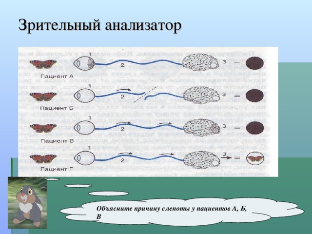 Зрительный анализатор Объясните причину слепоты у пациентов А, Б, В 