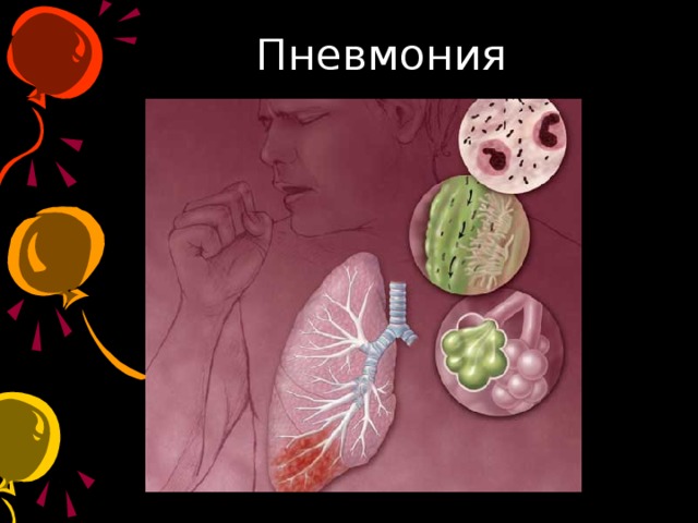 Пневмония 