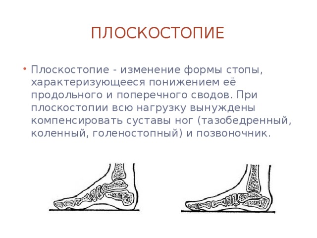 В каком случае используется средство первой помощи изображенное на рисунке плоскостопие радикулит