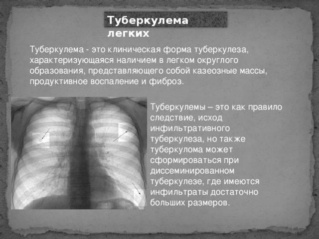 Туберкулема легких Туберкулема - это клиническая форма туберкулеза, характеризующаяся наличием в легком округлого образования, представляющего собой казеозные массы, продуктивное воспаление и фиброз. Туберкулемы – это как правило следствие, исход инфильтративного туберкулеза, но также туберкулома может сформироваться при диссеминированном туберкулезе, где имеются инфильтраты достаточно больших размеров. 