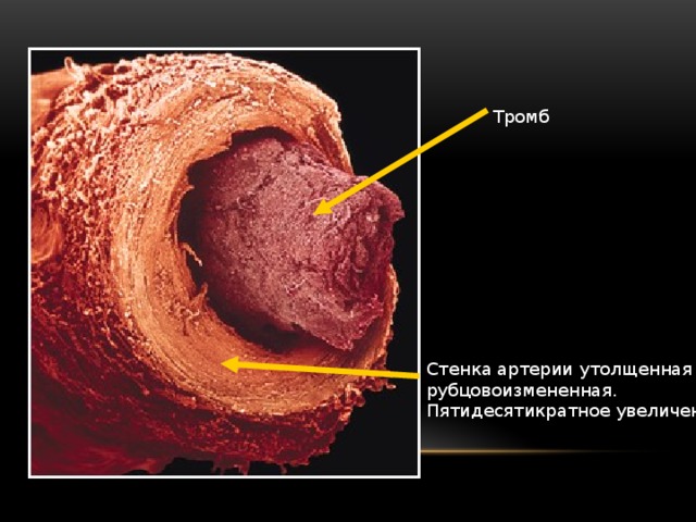 Основной тромб. Стена тромба. Утолщение стенок артерий. Утолщенная стенка артерии.
