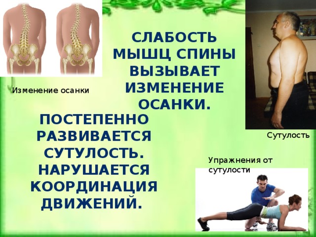 Болезнь слабости мышц. Изменение осанки. Общая мышечная слабость. Мышцы спины осанка сутулость.