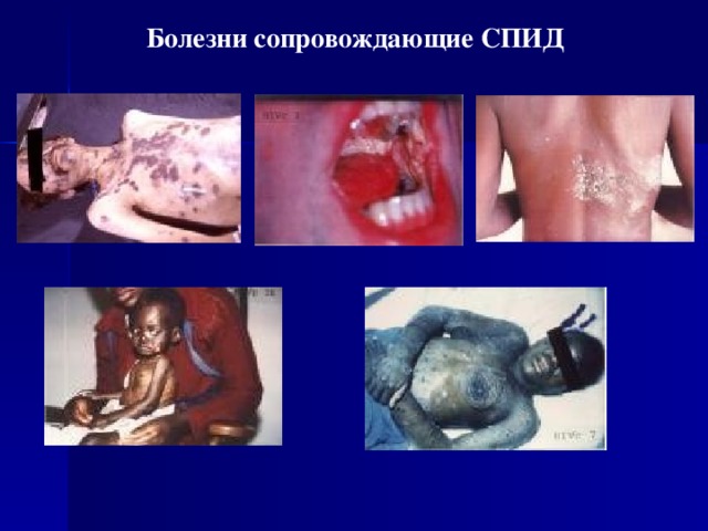 Болезни сопровождающие СПИД  