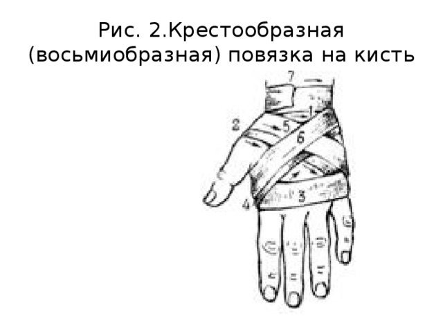 Восьмиобразная повязка. Восьмиобразная повязка на кисть. Крестообразная повязка на лучезапястный сустав алгоритм. Восьмиобразная повязка на кисть алгоритм. Крестообразная (восьмиобразная) повязка на кисть.