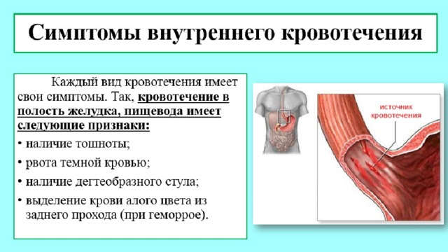 Стул при внутреннем кровотечении