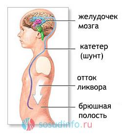 Программируемый VP-шунт: информация для детей, … Foto 17