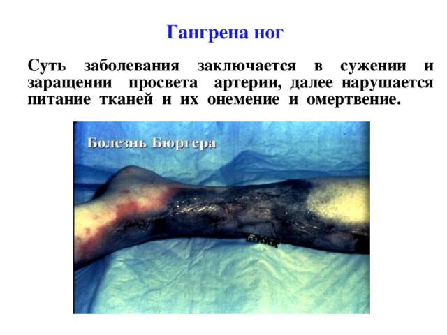 Гангрена ног Суть заболевания заключается в сужении и заращении просвета артерии, далее нарушается питание тканей и их онемение и омертвение. 