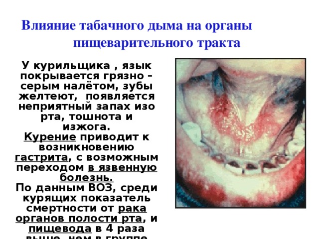 Влияние табачного дыма на органы    пищеварительного тракта У курильщика , язык покрывается грязно – серым налётом, зубы желтеют, появляется неприятный запах изо рта, тошнота и изжога. Курение приводит к возникновению гастрита , с возможным переходом в язвенную болезнь. По данным ВОЗ, среди курящих показатель смертности от рака  органов полости рта , и пищевода в 4 раза выше, чем в группе некурящих 