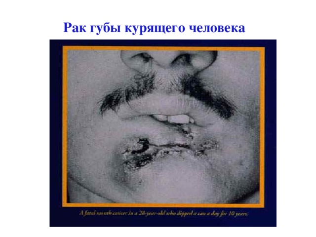 Рак губы курящего человека 