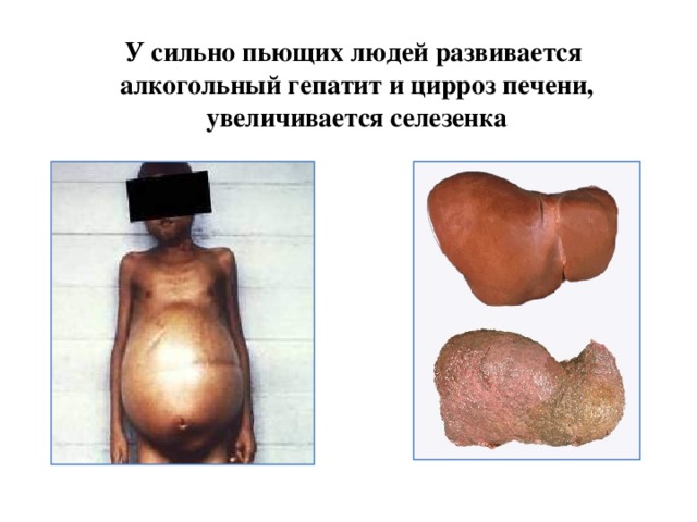 У сильно пьющих людей развивается алкогольный гепатит и цирроз печени, увеличивается селезенка 