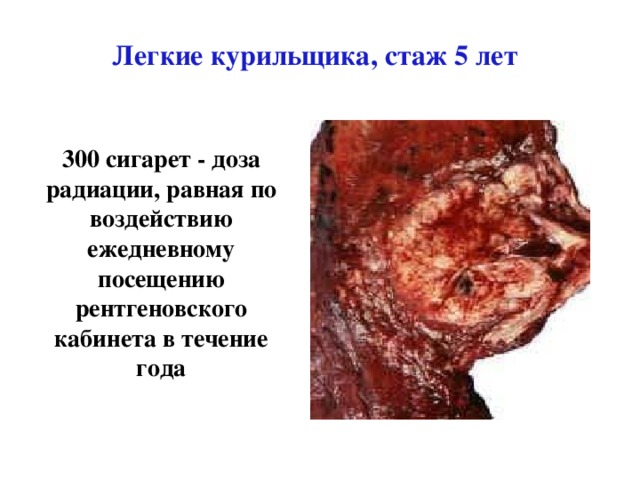 Легкие курильщика, стаж 5 лет 300 сигарет - доза радиации, равная по воздействию ежедневному посещению рентгеновского кабинета в течение года 