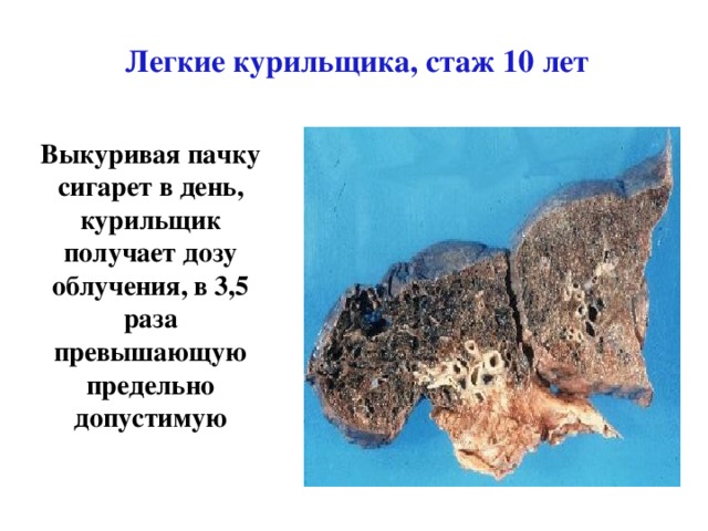 Легкие курильщика, стаж 10 лет Выкуривая пачку сигарет в день, курильщик получает дозу облучения, в 3,5 раза превышающую предельно допустимую 