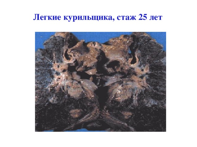 Легкие курильщика, стаж 25 лет 