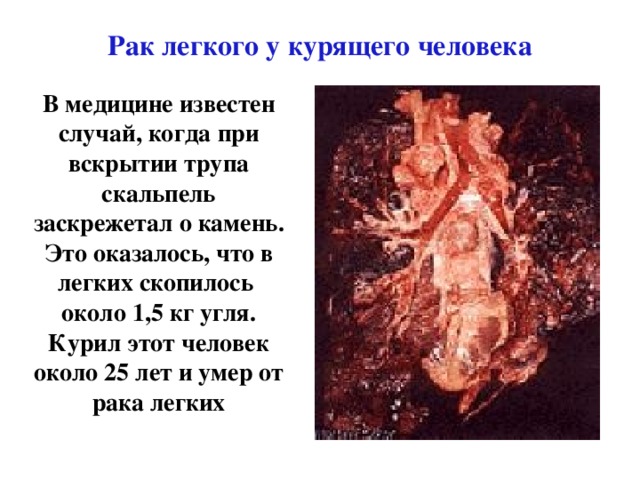Рак легкого у курящего человека В медицине известен случай, когда при вскрытии трупа скальпель заскрежетал о камень. Это оказалось, что в легких скопилось около 1,5 кг угля. Курил этот человек около 25 лет и умер от рака легких 