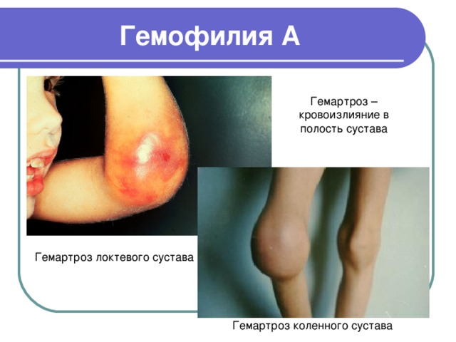 Гемофилия А Гемартроз – кровоизлияние в полость сустава Гемартроз локтевого сустава Гемартроз коленного сустава 