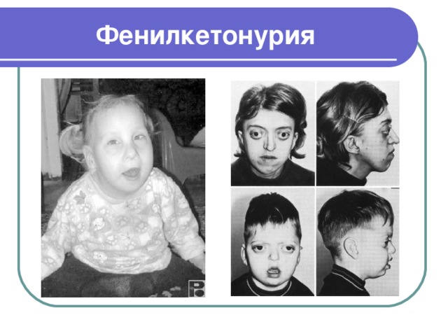 Фенилкетонурия 