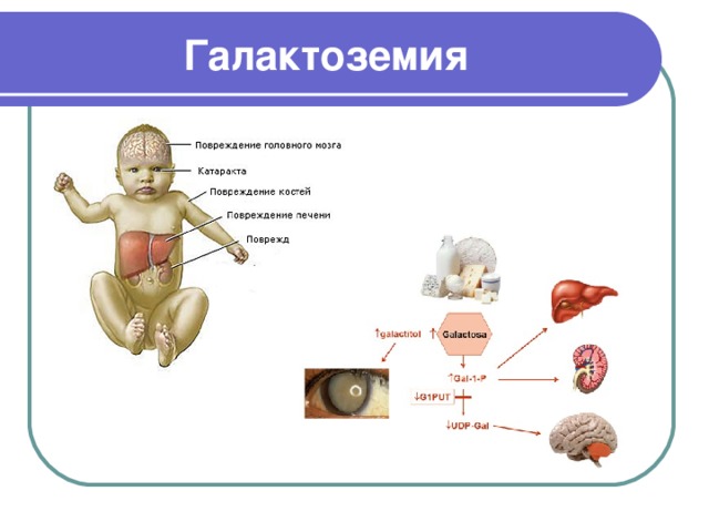 Галактоземия презентация по педиатрии