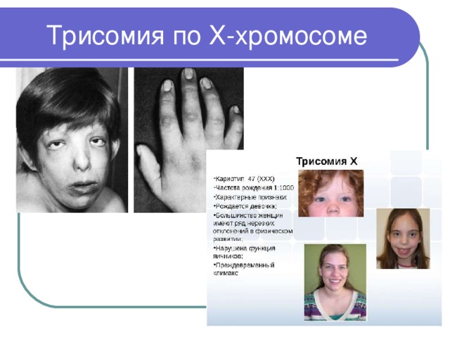 Синдром дисомии по у хромосоме фото
