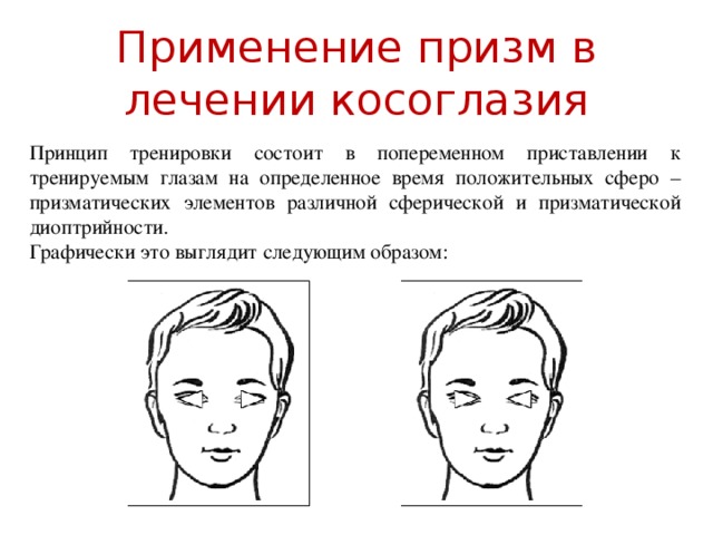Применение призм в лечении косоглазия Принцип тренировки состоит в попеременном приставлении к тренируемым глазам на определенное время положительных сферо – призматических элементов различной сферической и призматической диоптрийности. Графически это выглядит следующим образом: 