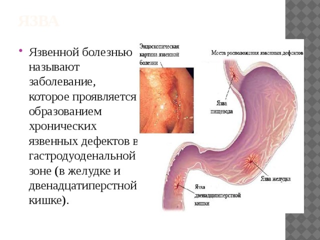 Язва луковицы дпк