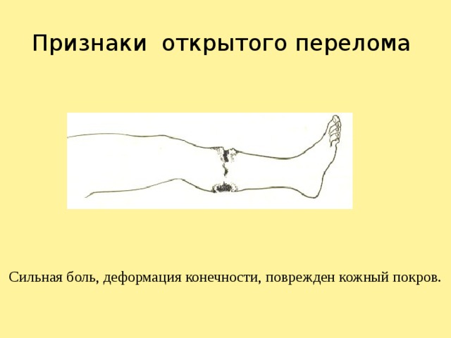 При открытом переломе тест. Признаки открытого перелома конечностей. Открытый перелом признаки. Признаки открытого перелома кости. Симптомы при открытом переломе.