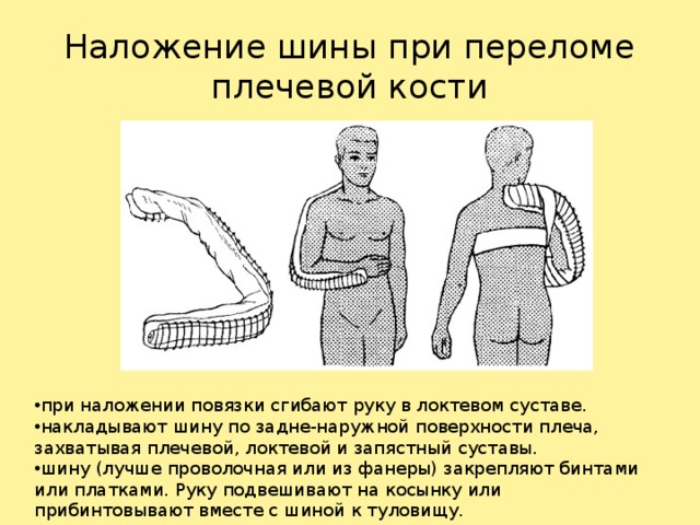 Шина при переломе костей. Наложение шины при переломе плечевой кости. Наложение транспортной шины при переломе плечевой кости. Перелом плечевой кости шина Крамера. Наложение шины Крамера алгоритм.