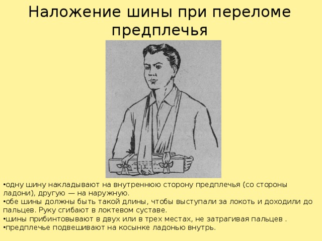 Техника наложения шин при переломах