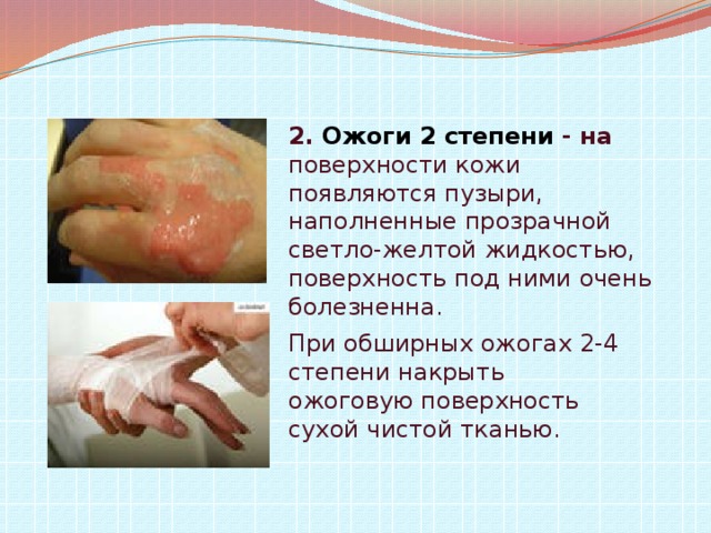 Первая помощь при ожогах